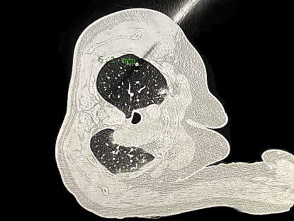 肺部穿刺导航机器人在沪投用，手术时间从半小时缩至10分钟(图1)