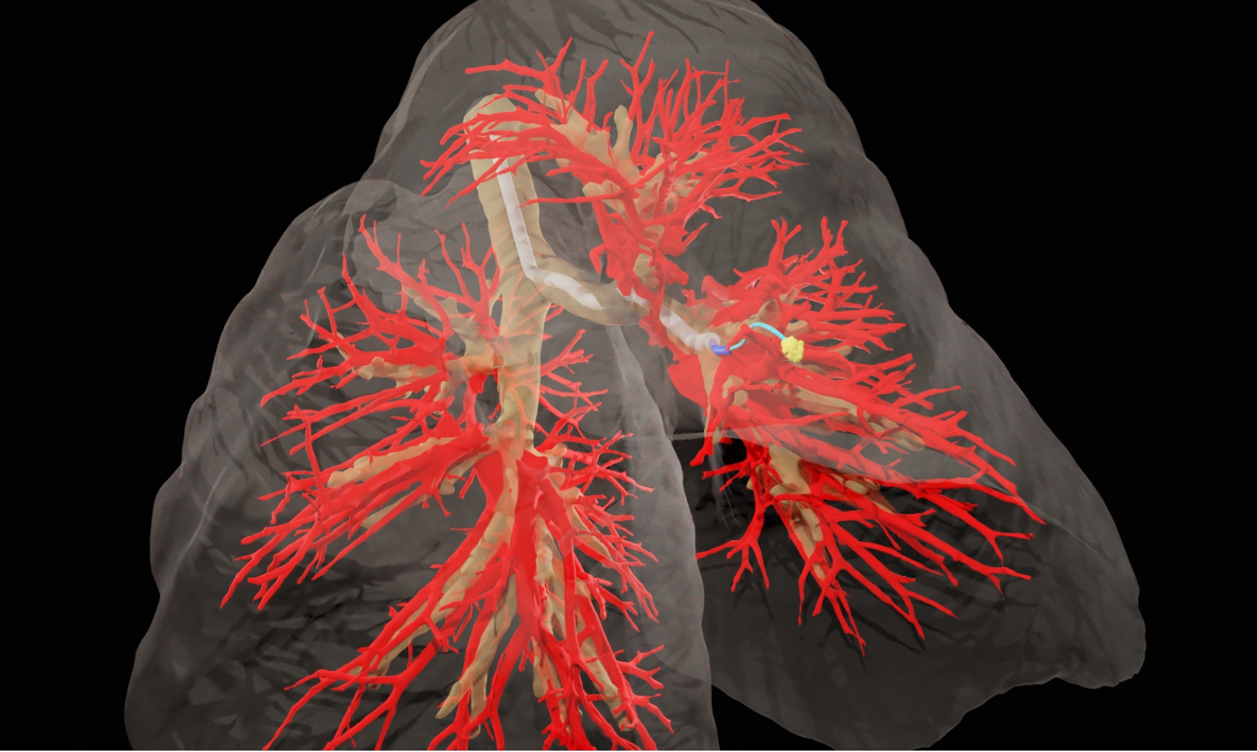 医疗机器人引导针穿过活体肺部(图1)